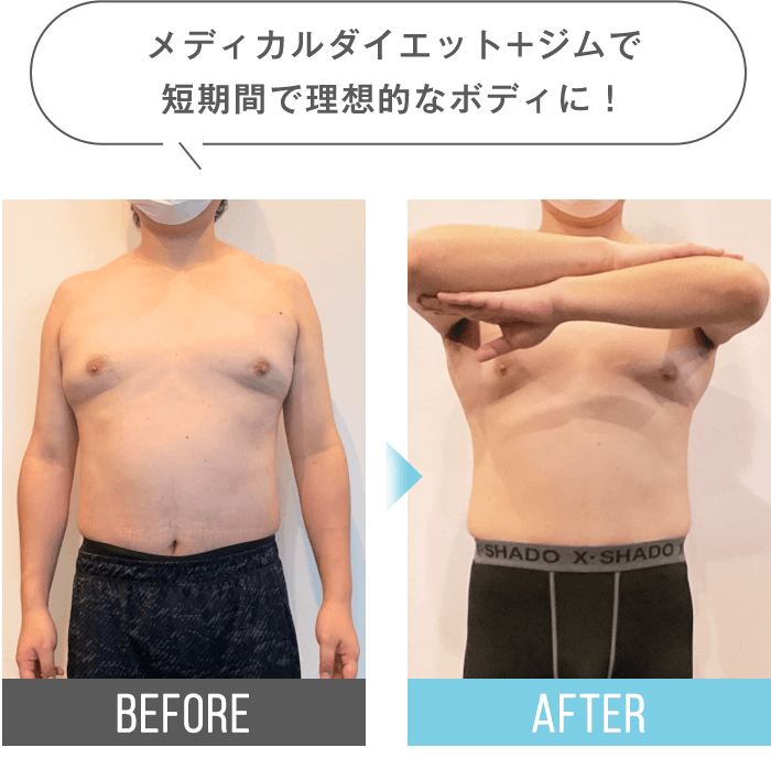 メディカルダイエット+ジムで短期間で理想的なボディに!
